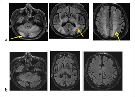 Journal of Neurological Research And Therapy-Reversible posterior encephalopathy syndrome