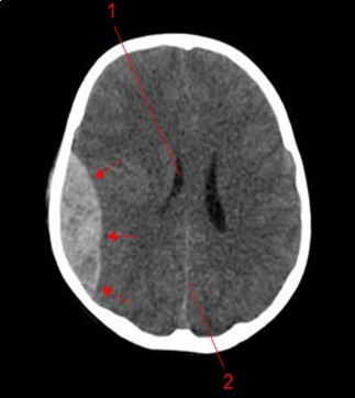 Journal of Neurological Research And Therapy-Head injury