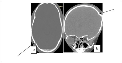 Journal of Neurological Research And Therapy-Head injury