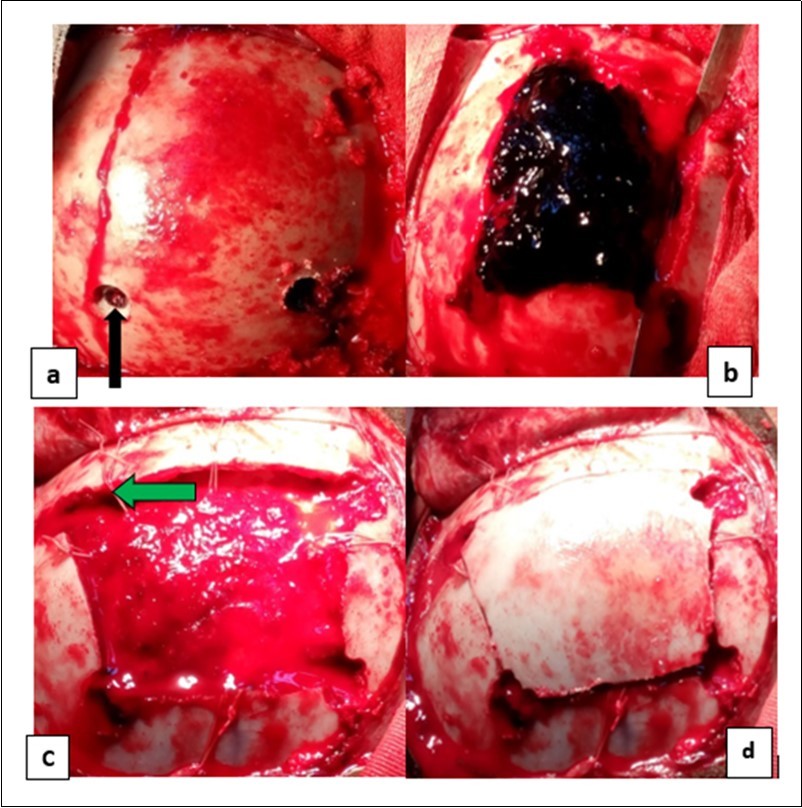 Journal of Neurological Research And Therapy-Head injury