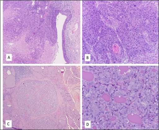 Journal of Aging Research And Healthcare-multiple neoplasms