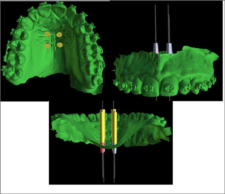 Journal of Dentistry And Oral Implants-mini-implant