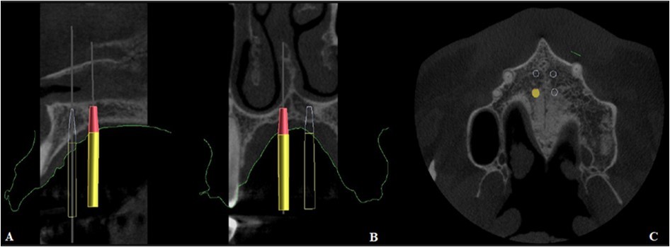 Journal of Dentistry And Oral Implants-mini-implant