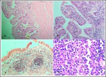 Cholelithiasis