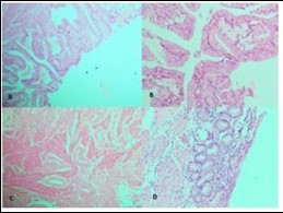 Cholelithiasis