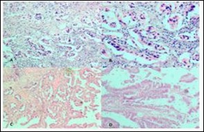 Cholelithiasis