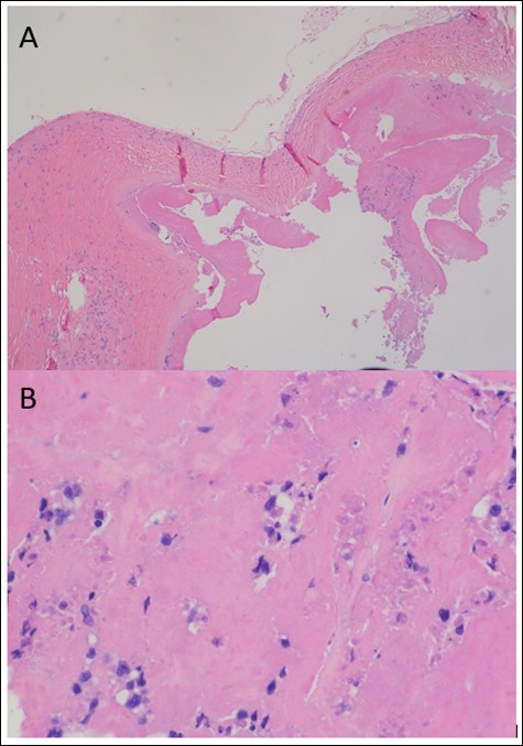 Journal of Hematalogy and Oncology Research-anaplastic large cell lymphoma