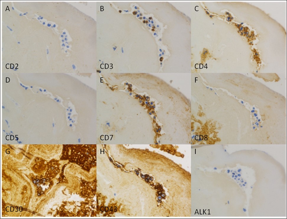 Journal of Hematalogy and Oncology Research-anaplastic large cell lymphoma