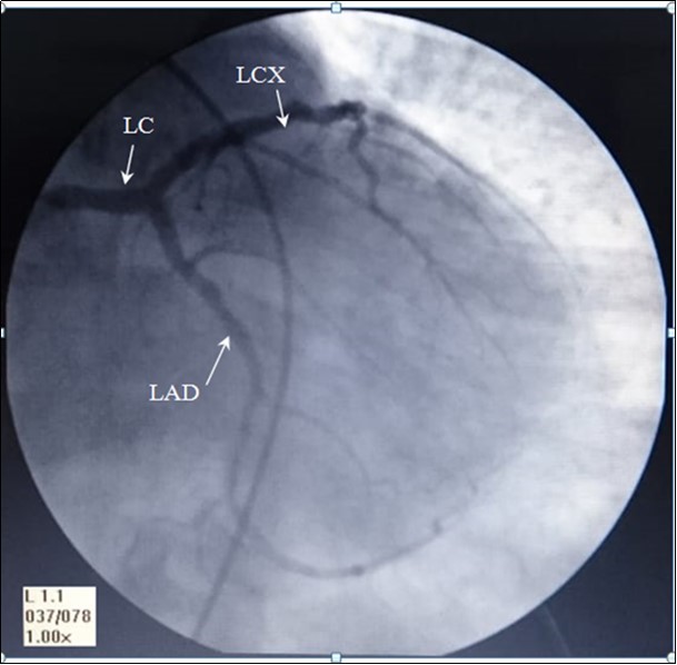 Journal Of Hypertension And Cardiology-Left coronary artery