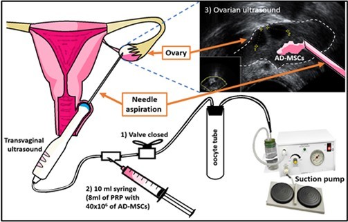 Journal Of Evolving Stem Cell Research-Premature ovarian insufficiency