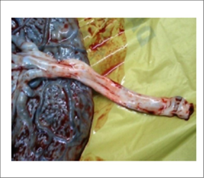 International Journal of Human Anatomy-Umbilical cord – Length – Neonate –APGAR score– Diameter