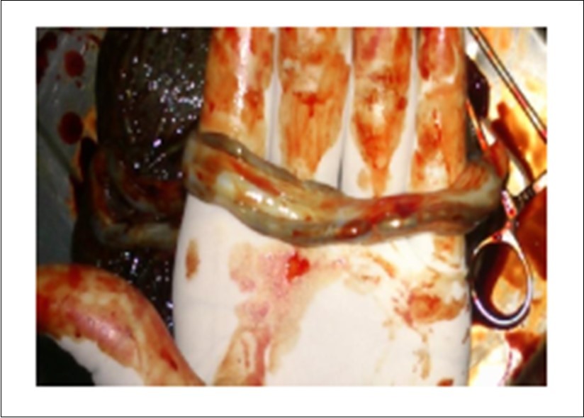 International Journal of Human Anatomy-Umbilical cord – Length – Neonate –APGAR score– Diameter