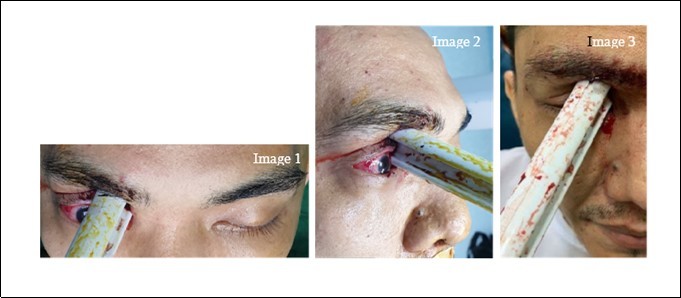 Journal of Ophthalmic Science-Orbitocranial penetrating injury