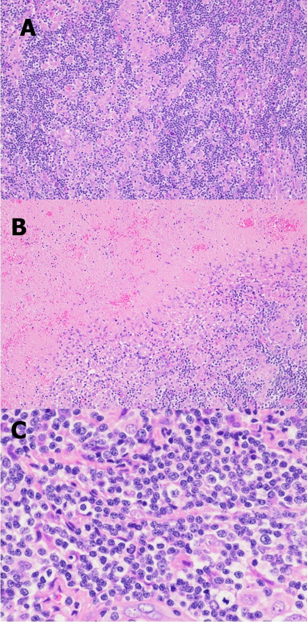 Journal of Hematalogy and Oncology Research-Lennert lymphoma