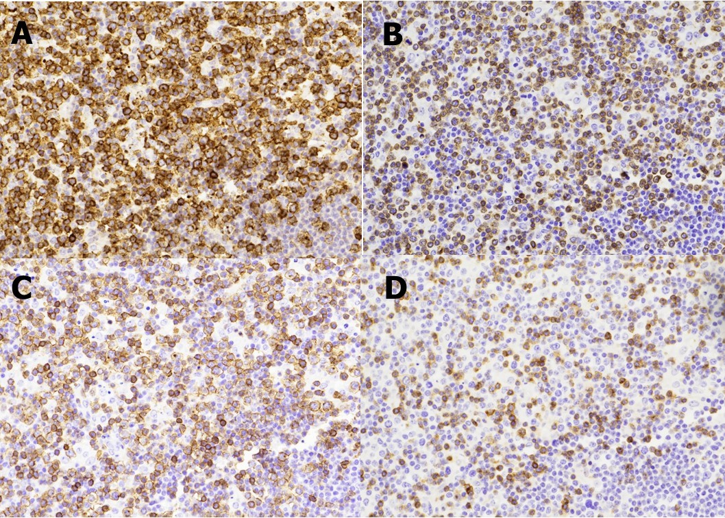 Journal of Hematalogy and Oncology Research-Lennert lymphoma