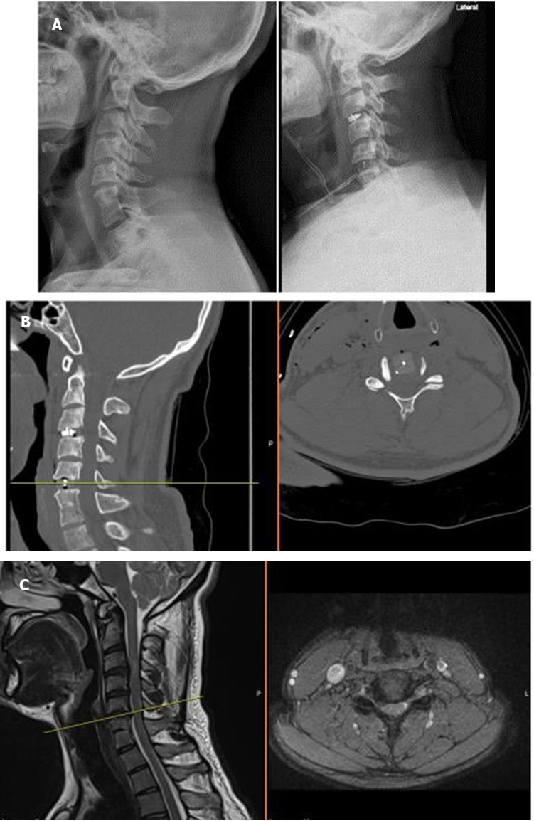 Journal of Current Scientific Research-Klippel-Feil Syndrome