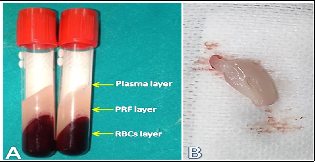 Journal of Veterinary Healthcare-Platelet Rich Fibrin