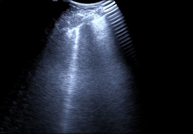 Journal of Etiological Diagnosis-Covid-19. pulmonary thromboembolism