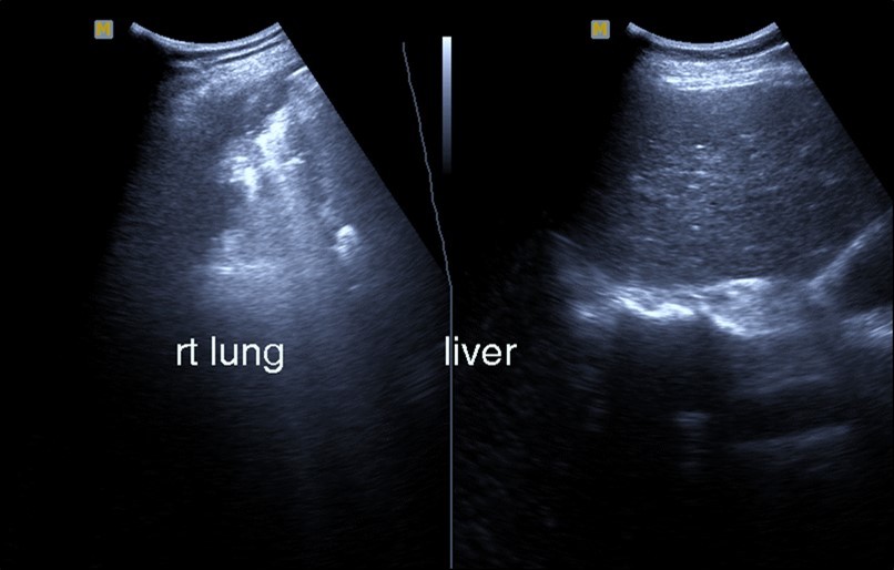 Journal of Etiological Diagnosis-Covid-19. pulmonary thromboembolism