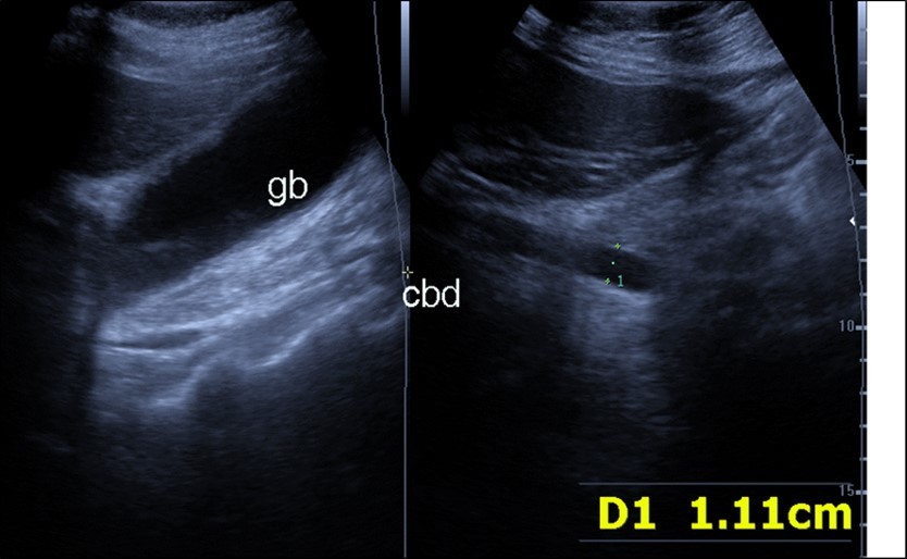 Journal of Etiological Diagnosis-Covid-19. pulmonary thromboembolism