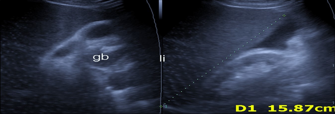 Journal of Etiological Diagnosis-Covid-19. pulmonary thromboembolism