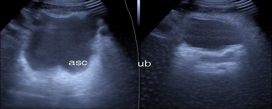 Journal of Etiological Diagnosis-Covid-19. pulmonary thromboembolism