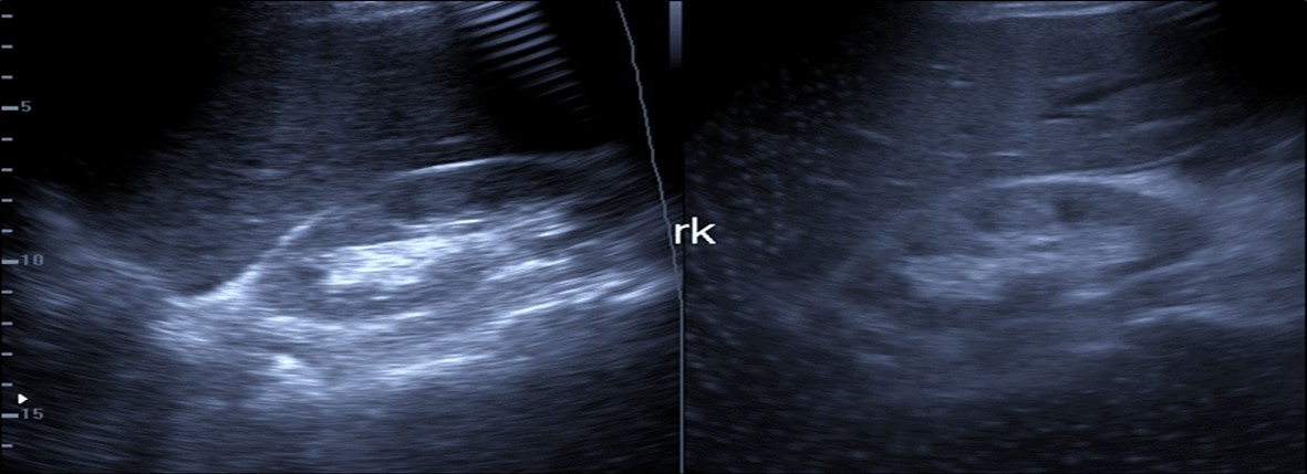 Journal of Etiological Diagnosis-Covid-19. pulmonary thromboembolism