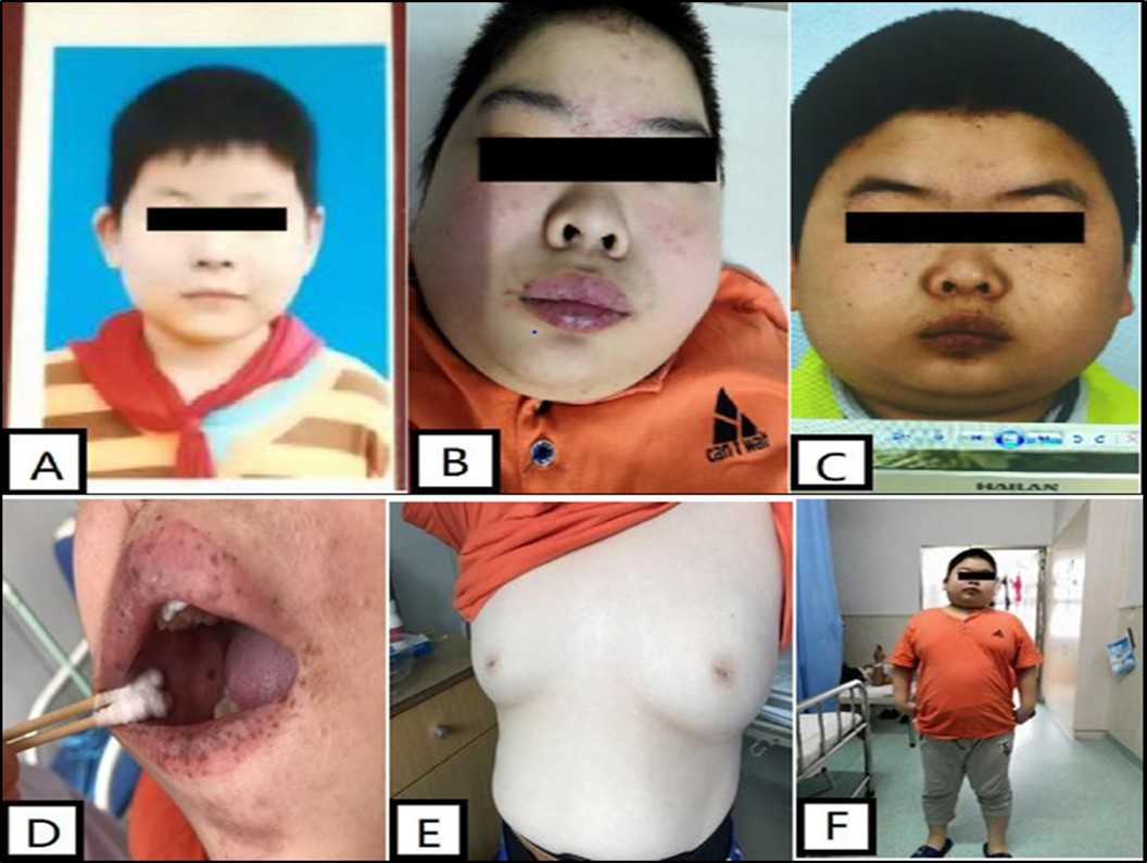 Journal of Clinical Case reports and Images-Carney complex