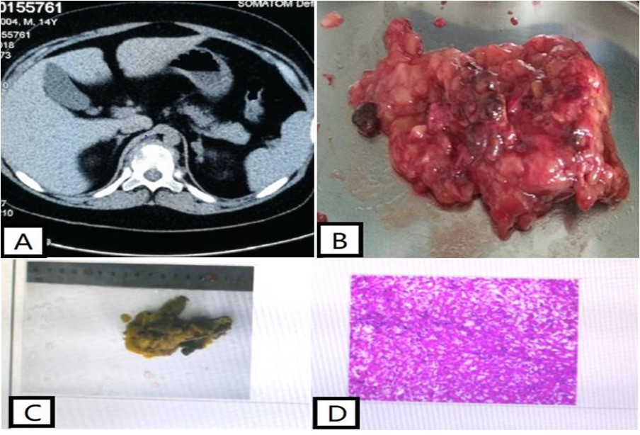 Journal of Clinical Case reports and Images-Carney complex