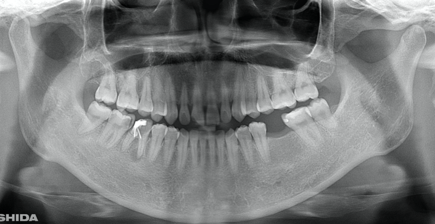 Journal of Dentistry And Oral Implants-Auto transplantation