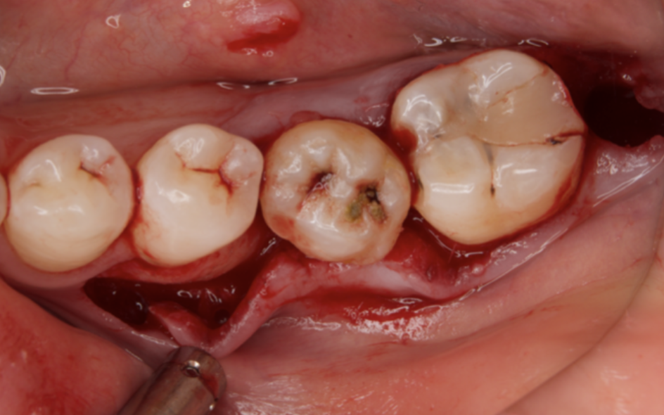 Journal of Dentistry And Oral Implants-Auto transplantation