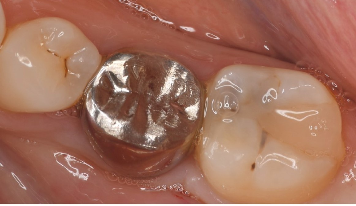 Journal of Dentistry And Oral Implants-Auto transplantation
