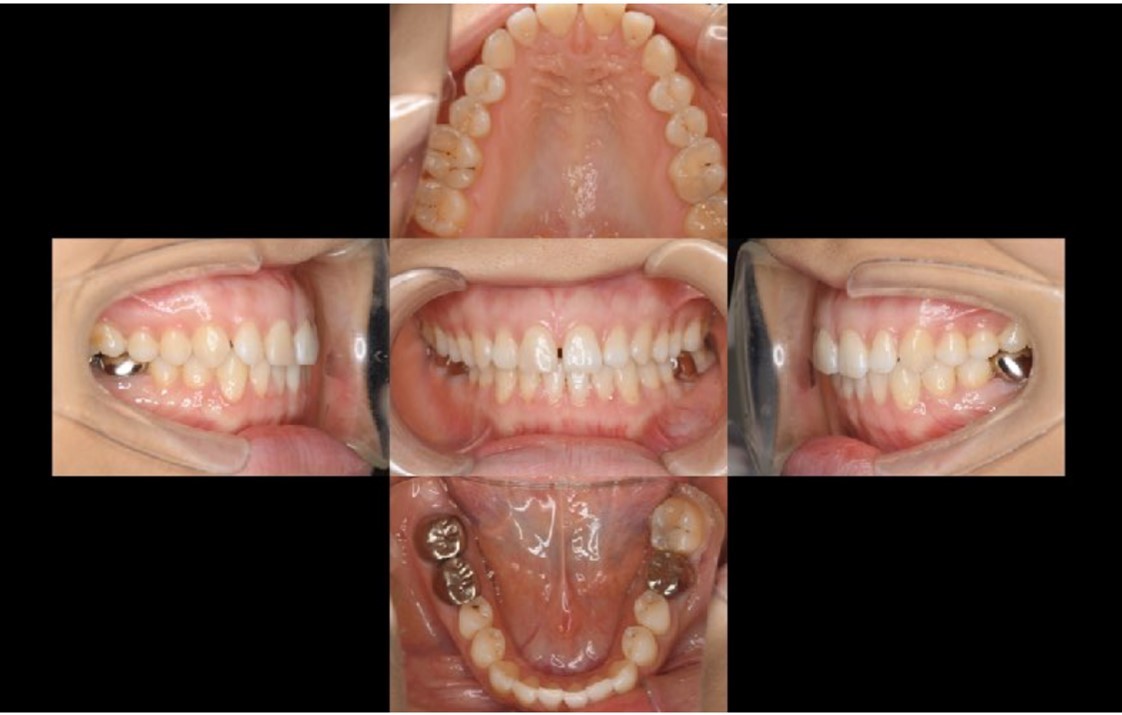 Journal of Dentistry And Oral Implants-Auto transplantation