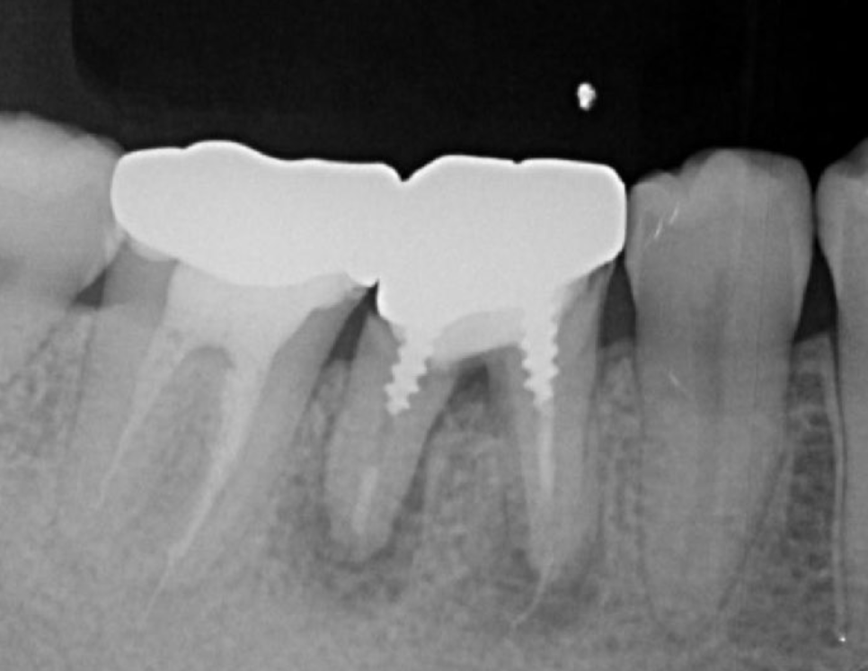 Journal of Dentistry And Oral Implants-Auto transplantation