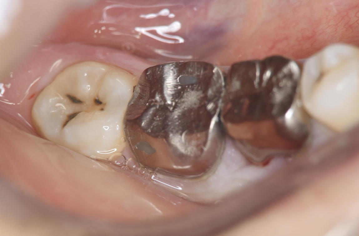 Journal of Dentistry And Oral Implants-Auto transplantation