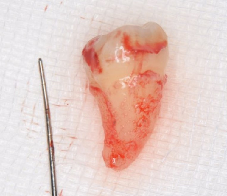 Journal of Dentistry And Oral Implants-Auto transplantation