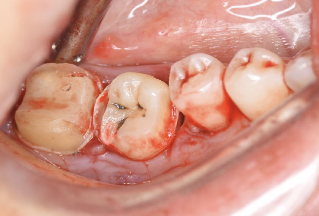 Journal of Dentistry And Oral Implants-Auto transplantation