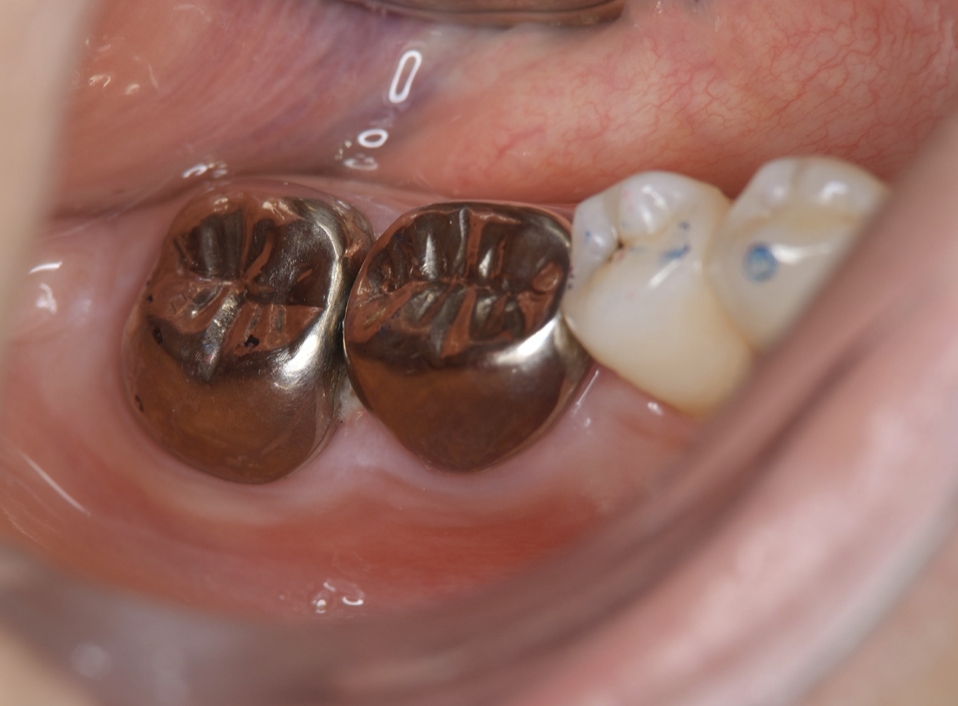 Journal of Dentistry And Oral Implants-Auto transplantation