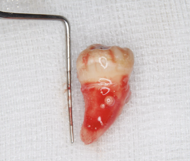 Journal of Dentistry And Oral Implants-Auto transplantation