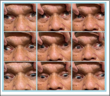 Journal of Ophthalmic Science-Bilateral Internuclear Ophthalmoplegia