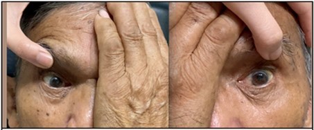 Journal of Ophthalmic Science-Bilateral Internuclear Ophthalmoplegia