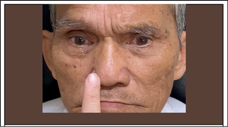 Journal of Ophthalmic Science-Bilateral Internuclear Ophthalmoplegia