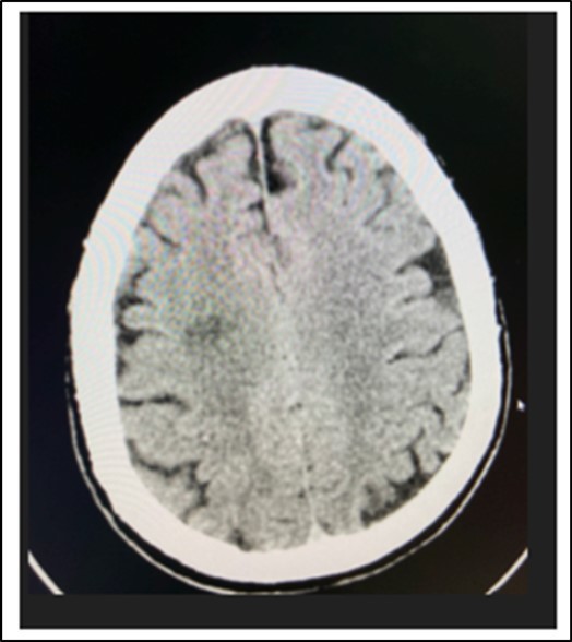Journal of Ophthalmic Science-Bilateral Internuclear Ophthalmoplegia