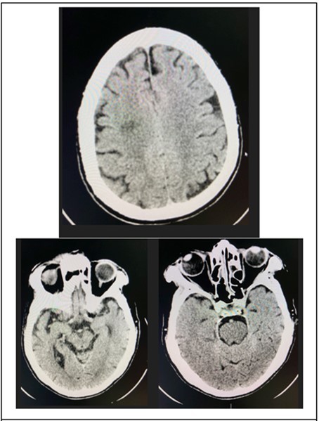 Journal of Ophthalmic Science-Bilateral Internuclear Ophthalmoplegia