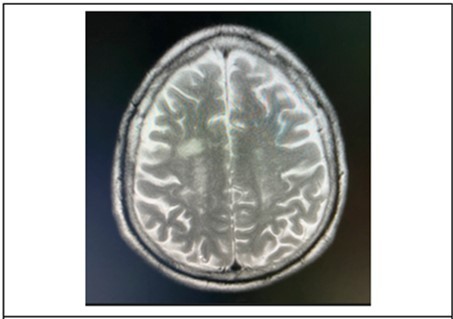 Journal of Ophthalmic Science-Bilateral Internuclear Ophthalmoplegia