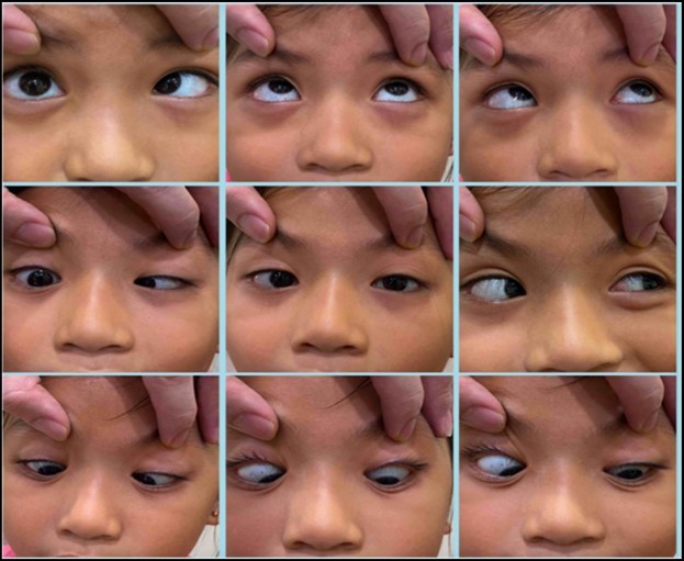 Journal of Ophthalmic Science-Raymond syndrome