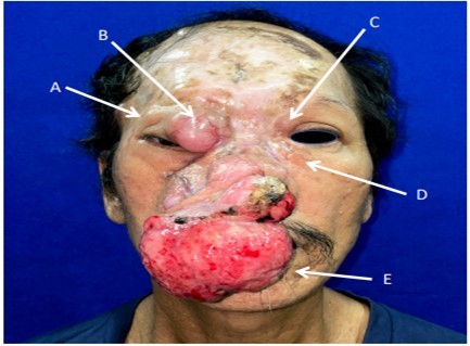 Journal of Ophthalmic Science-Neurofibroma