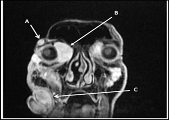 Journal of Ophthalmic Science-Neurofibroma