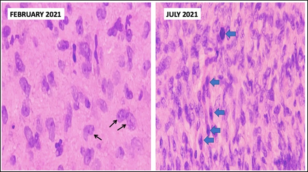 Journal of Ophthalmic Science-Neurofibroma