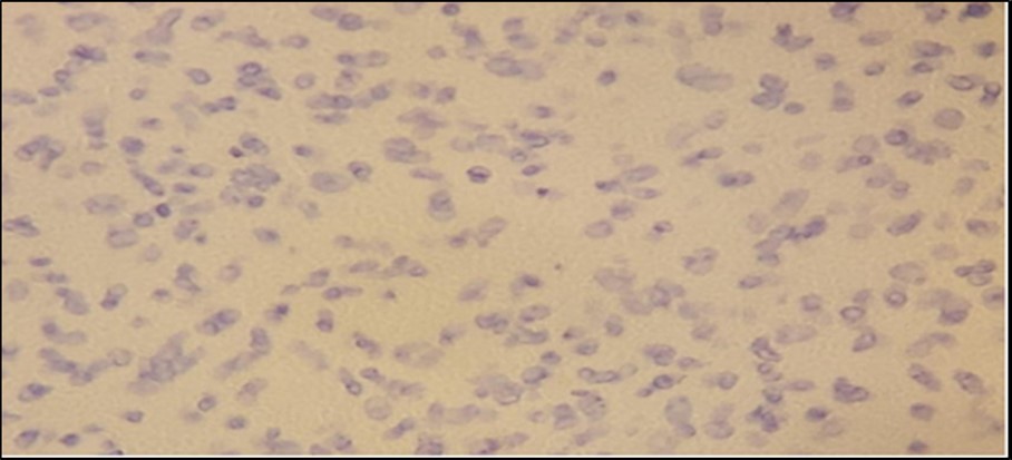 Journal of Ophthalmic Science-Neurofibroma